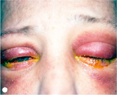 conjuntivitis virica recurrente