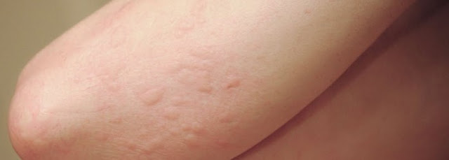 skin rash that itches and hurts