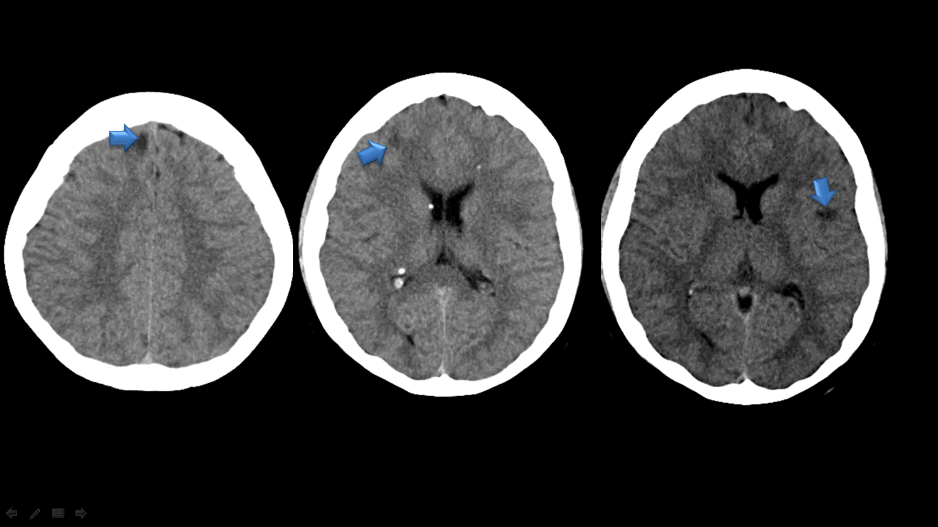 Ultimate Radiology Plain CT Brain findings in an