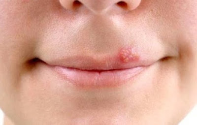 Herpes môi (mụn rộp ở môi) có thể điều trị hiệu quả bằng thuốc