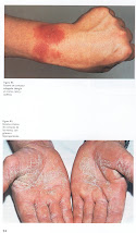 DERMATITIS