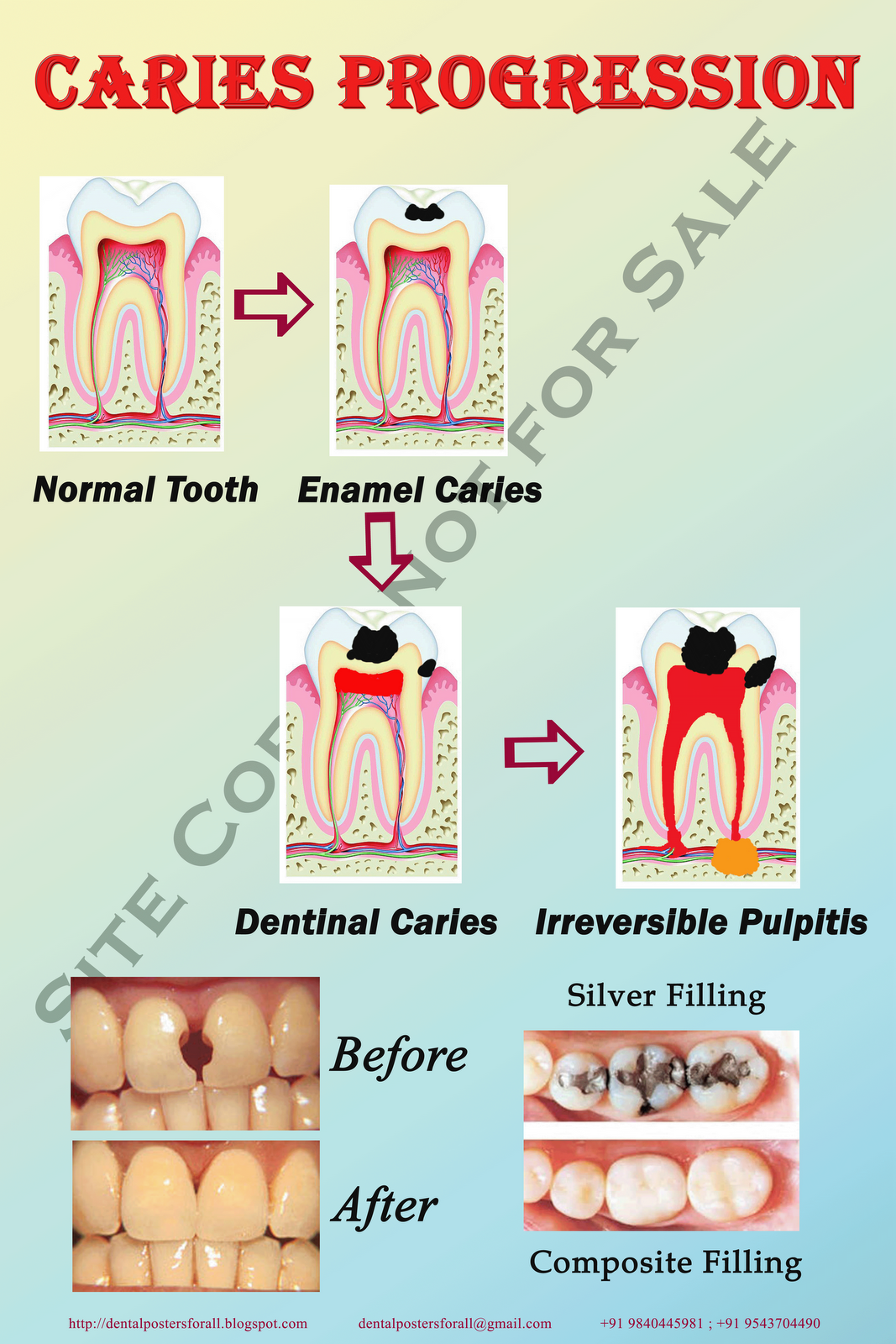 Dental Posters to Educate Patients Caries Progression