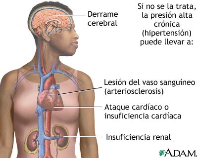 Presión arterial alta si no se trata