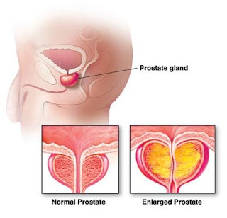 prostatita inflamație a uretrei