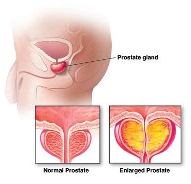 Prostatită comună cu alun