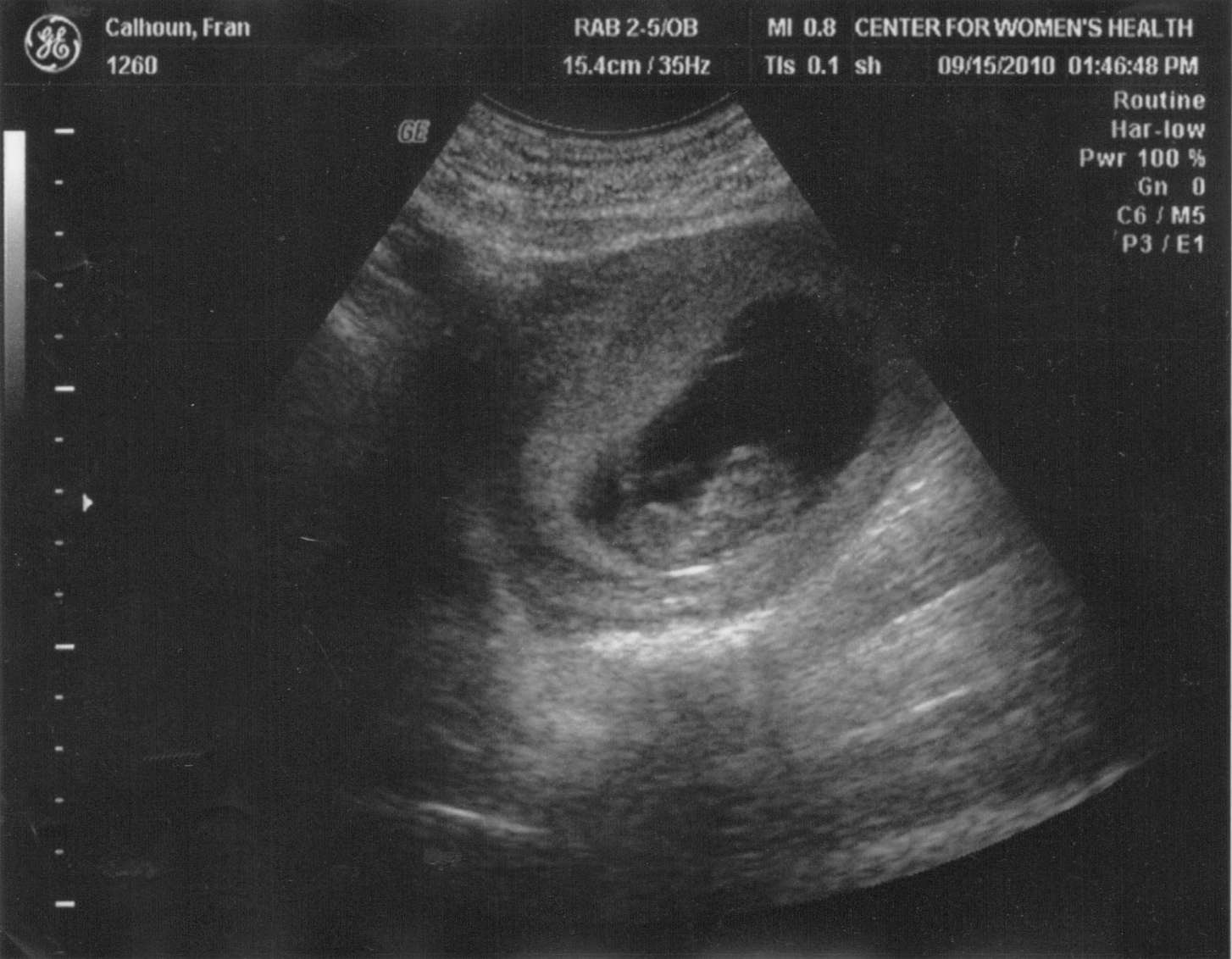 Беременна 1 месяц беременности. Снимок УЗИ на 3 месяце беременности. На 2 и 3 месяц беременности на УЗИ. Фото УЗИ беременности 1 месяц. Беременность 1 месяц фото эмбриона на УЗИ.