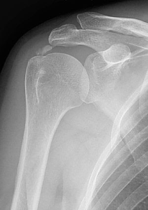 a vállízület röntgen képe az ízületi fájdalmakról