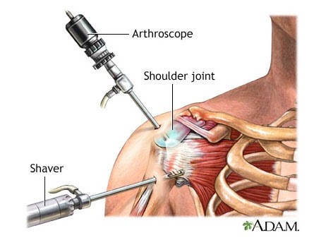 artroszkópos vállízület kezelés)