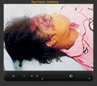 Lisa Lopes Autopsy Left Eye Autopsy. 