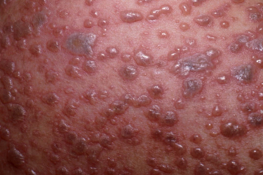 articole care au vindecat vene varicoase