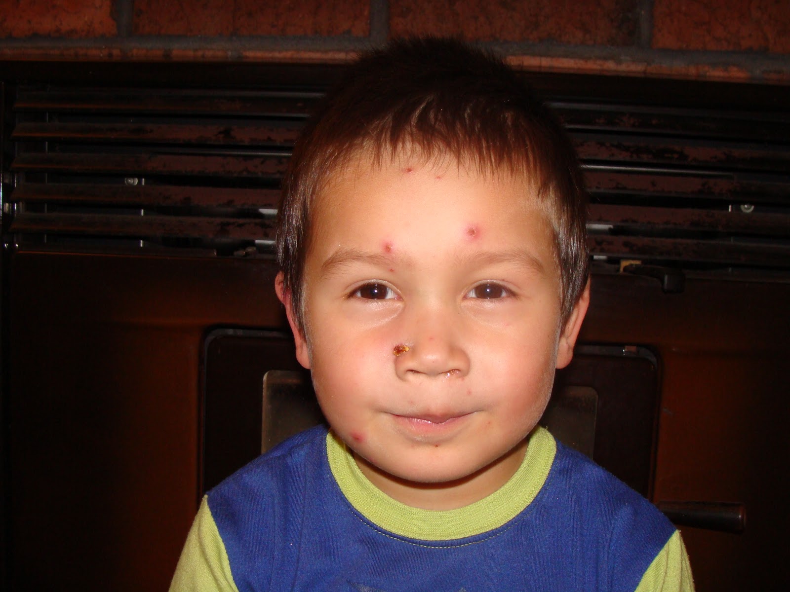 ryan-blinman-spotty-face