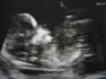 Profile @ 14 weeks