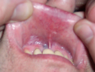 Redness Inside Mouth 16