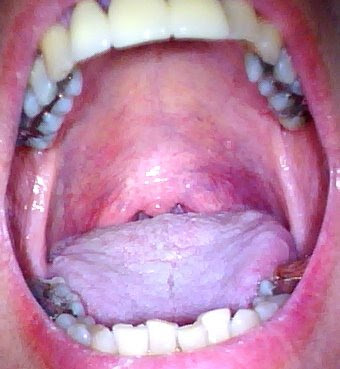 Bumps On Roof Of Mouth After Eating 22