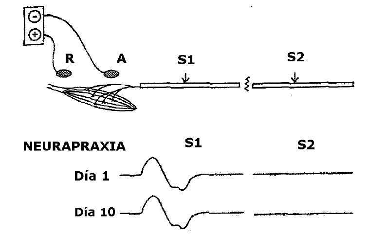 que es la electromiografia de fibra unica que es la electromiografia de fibra unica