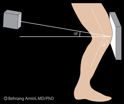 diagram showing technique for obtaining the Rosenberg view.