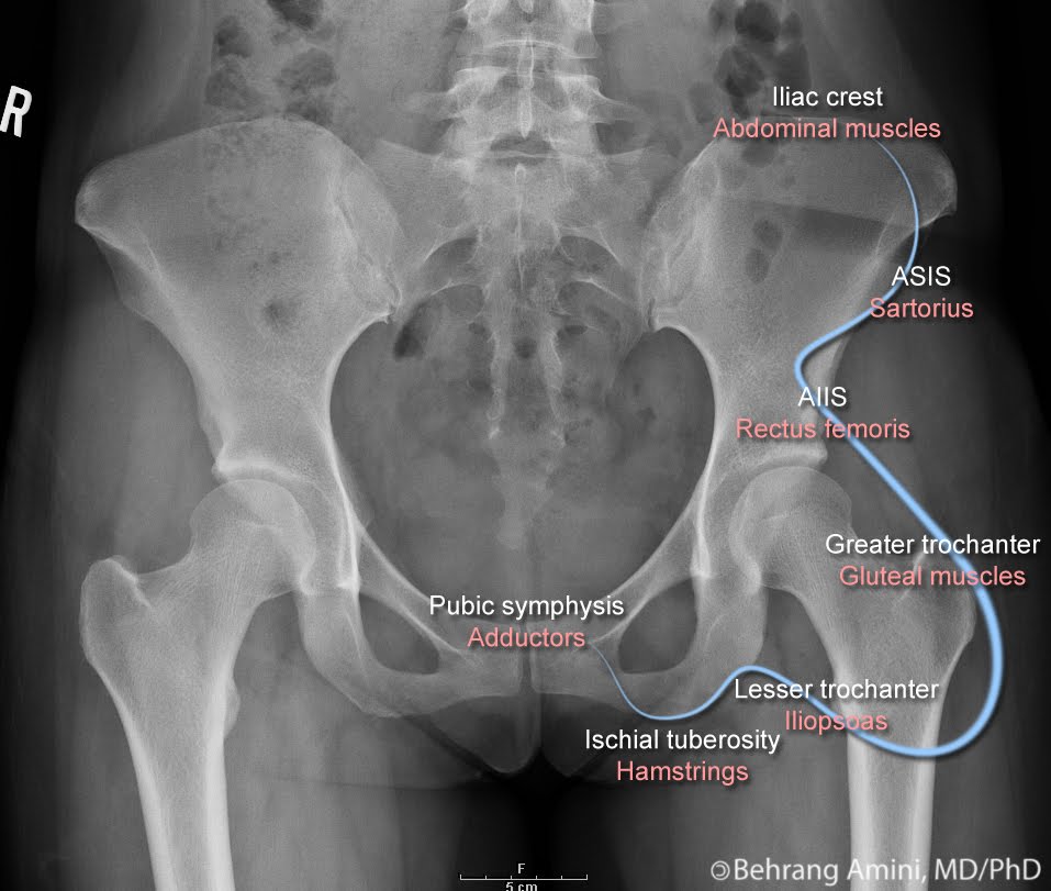 Avulsion Fracture Hip Iliac Crest