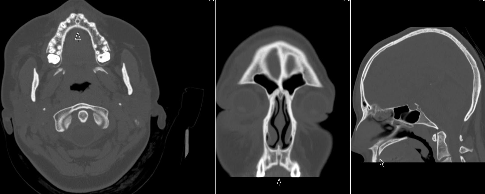 Incisive Canal Radiology Imaging