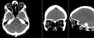 Radiology MRI: Optic Disc Drusen