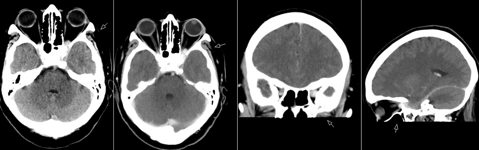 Radiology MRI: Tolosa-Hunt Syndrome
