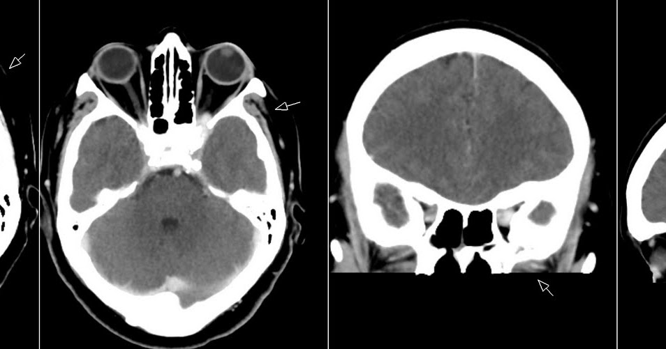 Radiology MRI: Tolosa-Hunt Syndrome