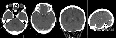 Cerebral Venous Sinus Thrombosis - Radiology Imaging