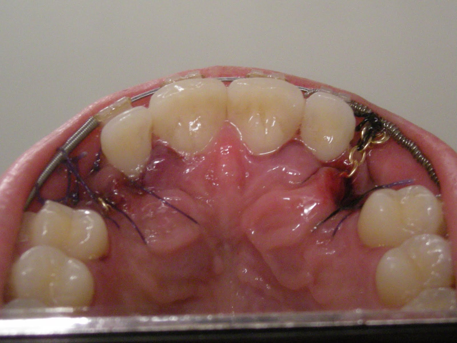 The Blakeys Teeth That Move