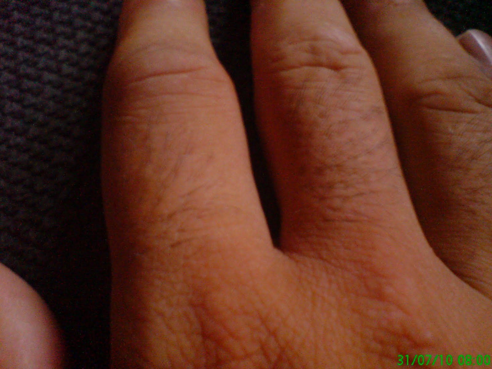 Ho Tirato Un Pugno E Mi Fa Male La Mano