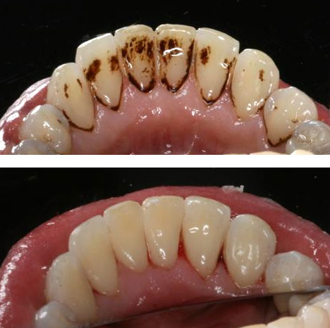 Dental caseiro com carvao clareamento