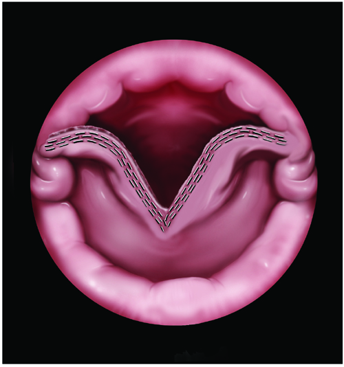 Zenker's Diverticulum Endoscopic Treatment Confusion Fauquier ENT Blog