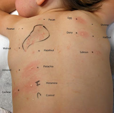 Allergy testing - skin: MedlinePlus Medical Encyclopedia
