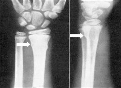 buckle fracture thumb buckle fracture thumb
