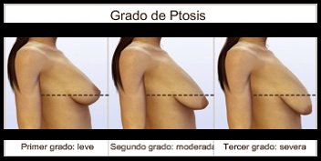 [grado+de+ptosis+copia.jpg]