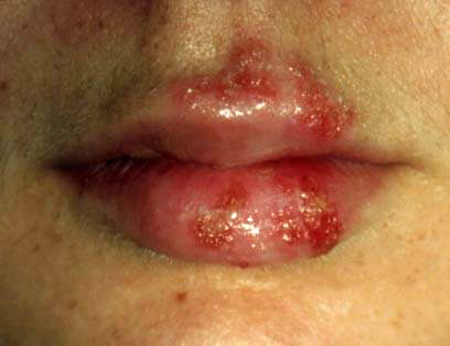 Herpes Pictures and Cold Sores Pictures - Verywell