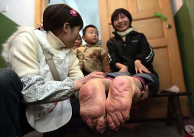 Woman with Feet Facing Backward in China