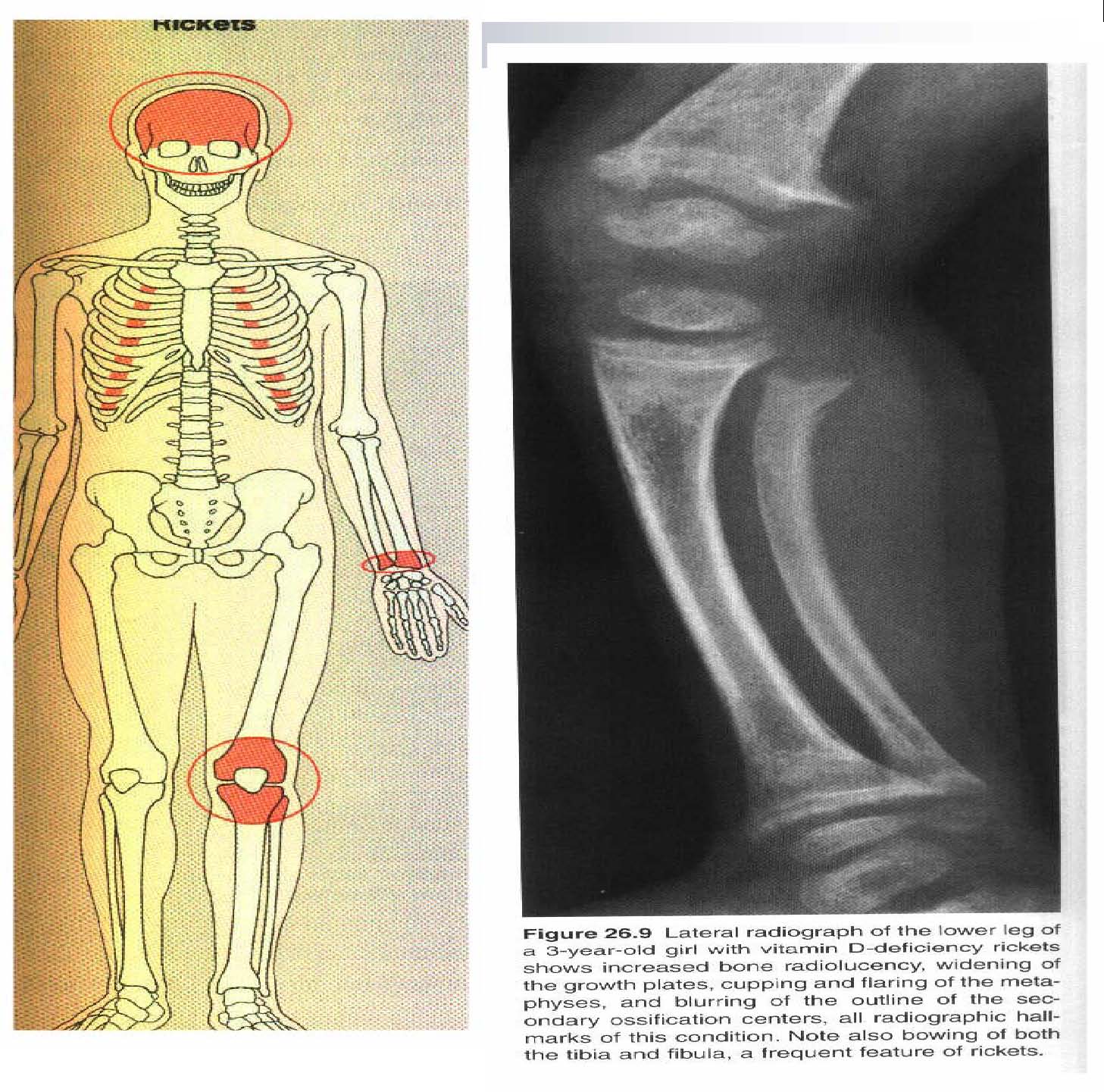 [METABOLÄ°K+KEMÄ°K+HASTALIKLARI_img_50.jpg]