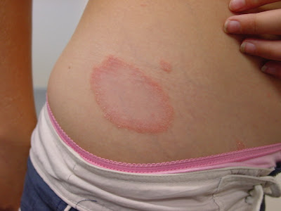 Pupp Pregnancy Rash-Coping with Pupps - Itchy Skin Rash