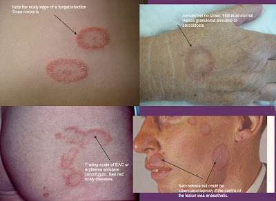 annular skin lesions