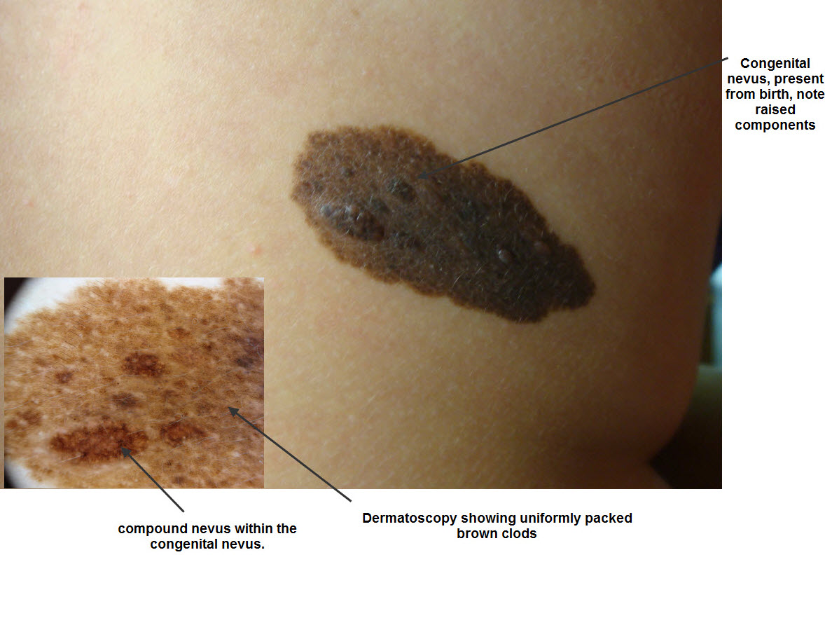 Congenital melanocytic nevi: Where are we now? - Huidhuis