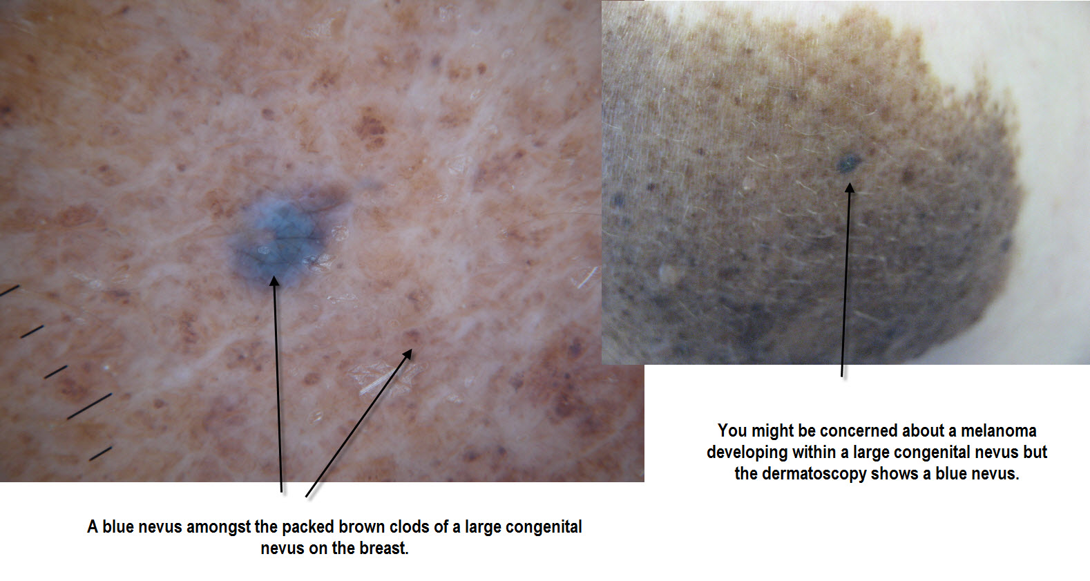 Blue nevus of the nail - wide 9