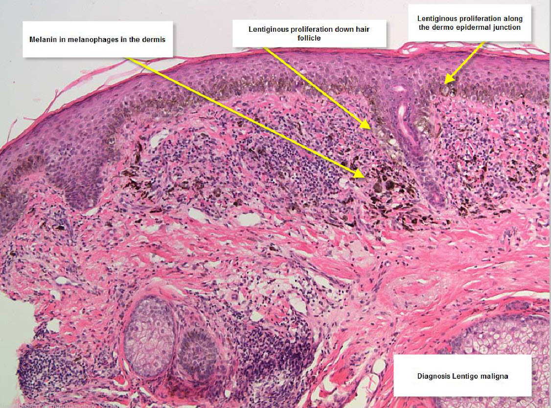 Histology of Melanoma and Other Skin Cancers | Cancer Network