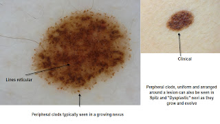 Dermoscopy Made Simple: Clark or Dysplastic nevi