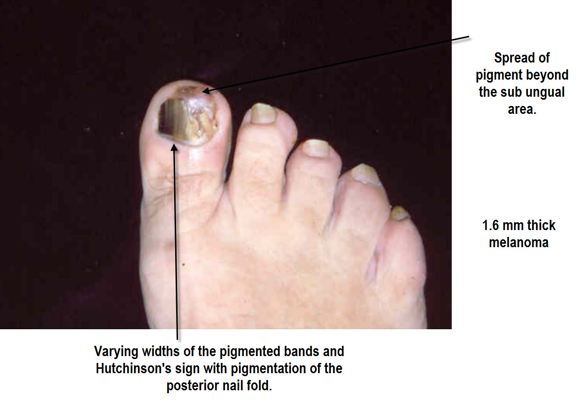 dermoscopy-made-simple-acral-and-subungual-melanoma