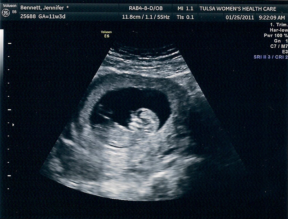 Малыш на 11 неделе. Эмбрион на 10 неделе беременности УЗИ. 10 Недель беременности фото плода на УЗИ. УЗИ плода на 11 неделе беременности.