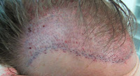 hair transplant: Sagittal vs. Coronal Incisions