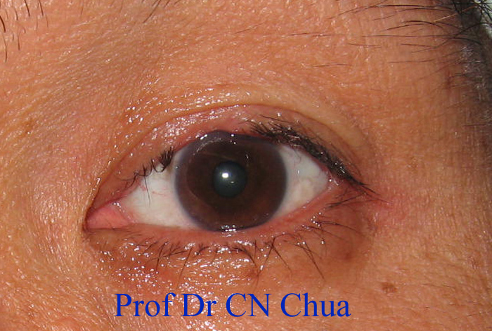 Eyelid Surgery by Prof Dr CN CHUA 蔡鐘能: My Eye Surgeon Did That to My ...