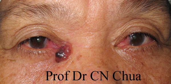 Eyelid Surgery by Prof Dr CN CHUA 蔡鐘能: Case 2: Excision of Basal Cell ...