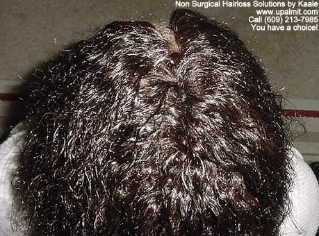 Tree Braids, Non Surgical Hair Loss Solutions: Before and ...