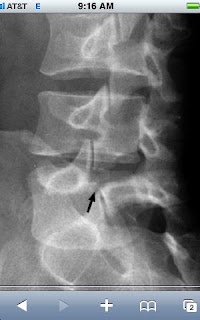 Pars Defect Injection Loose Mind Change Of Papa: Pars Defect