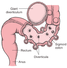 [diverticula.gif]